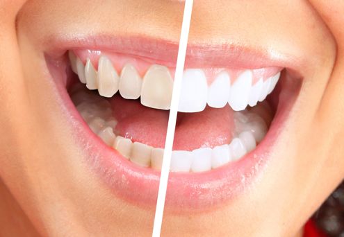 Teeth Whitening Coquitlam, Coquitlam Zoom Teeth Whitening